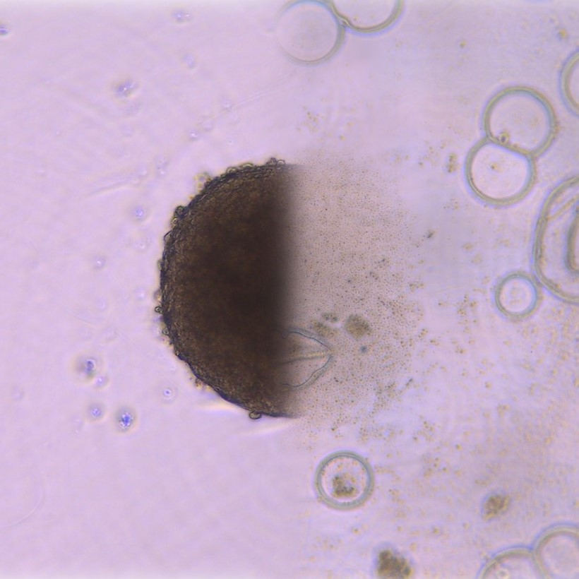 Against a pink backdrop, there are a number of small, out of focus, brown circles, spread about at random, including some that are clustered together. In the centre and foreground there is single cancer cell shown in black dying from the treatment.